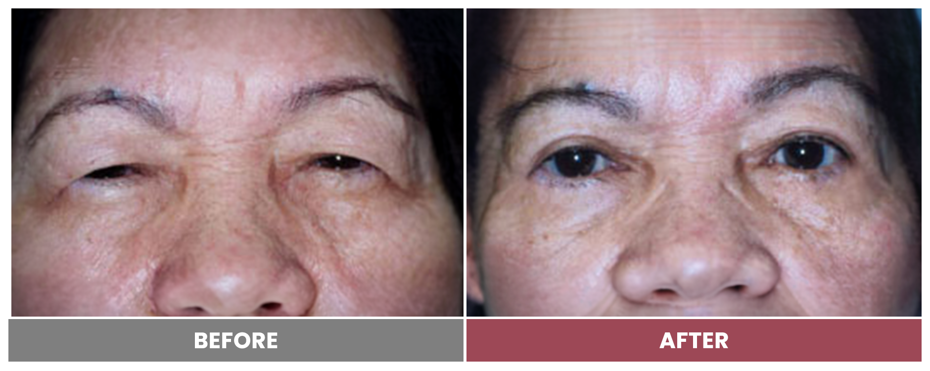 Upper Blepharoplasty - Case 97